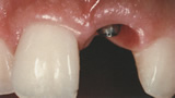 理想的なスキャロップ形態を示す歯肉縁の唇側面観 